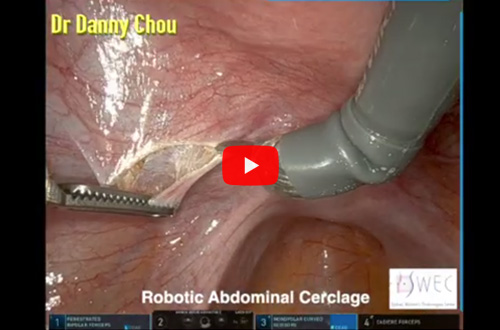 Rob Abdominal Cerclage