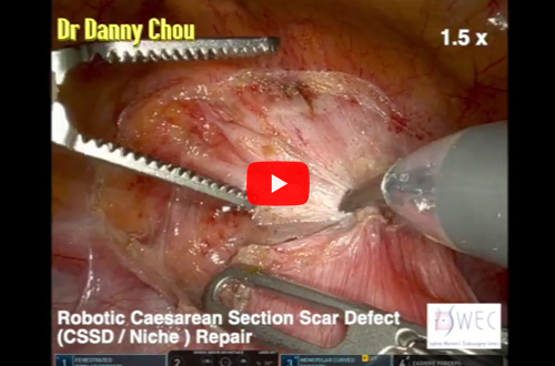 Rob Caesarean Section Scar Defect