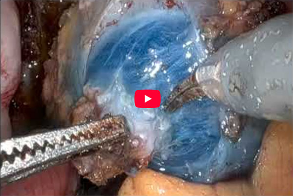 Sydney Shaving for Rectal Endometriosis